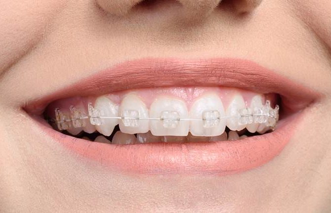 Information on transparent white dental braces